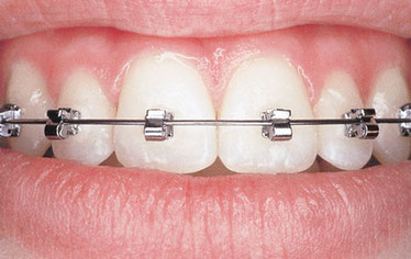 Festsitzende Zahnspange mit Metallbrackets