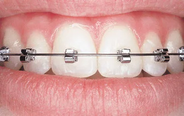 Festsitzende Zahnspange mit Metallbrackets